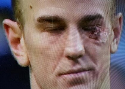 Manchester City: Joe Hart, che botta con Jerome! Foto